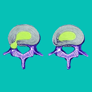 annulus fibrosus