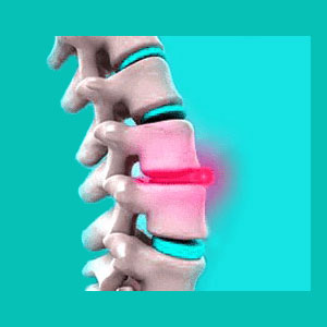 broad based herniated disc