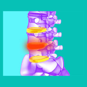 bulging disc therapy