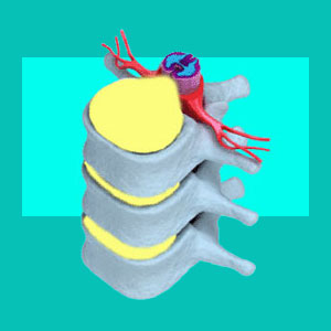 central herniated disc