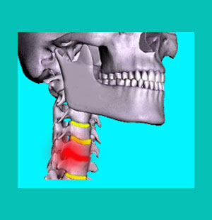 cervical bulging disc