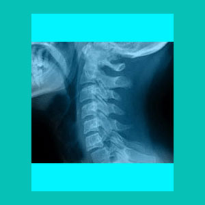 cervical herniated disc diagnosis