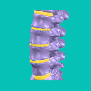 degenerative disc disease causes