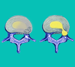 degenerative disc disease causes herniated discs