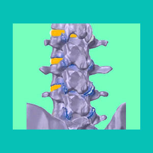 degenerative disc disease pain