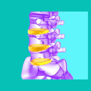 diagnosis of bulging discs