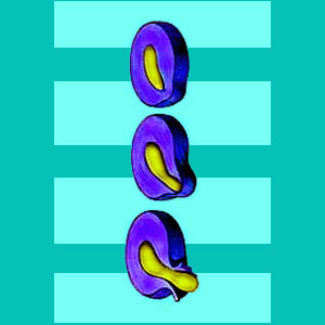 Difference Between a Bulging Disc and a Herniated Disc