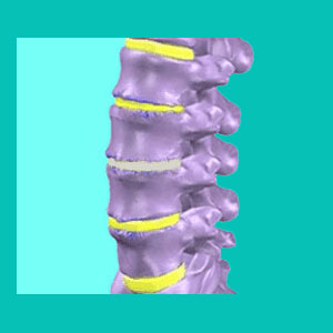 disc calcification