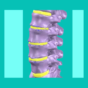 disc desiccation