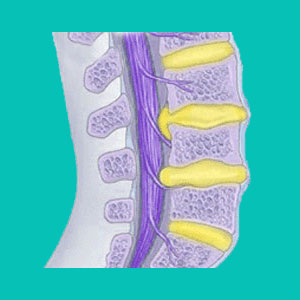 do herniated discs heal?