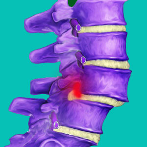 does spondylolisthesis cause herniated discs