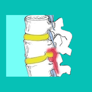 extraforaminal herniated disc