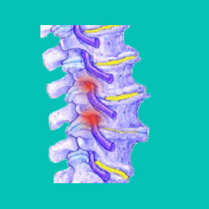 foraminal stenosis