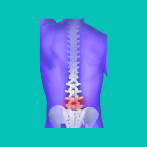 Glucosamine and Chondroitin for Herniated Discs