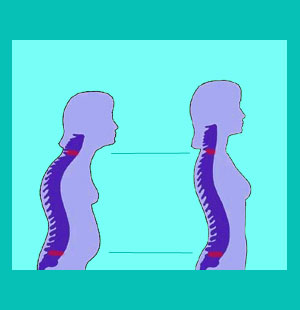 hereditary herniated discs