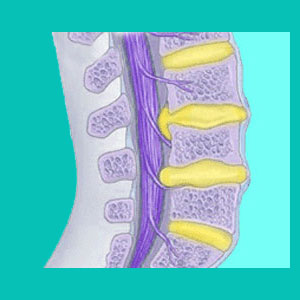 herniated disc abutting the spinal cord