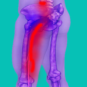 herniated disc hamstring pain