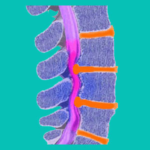 herniated disc compressing the spinal cord