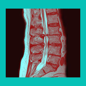 herniated disc diagnosis