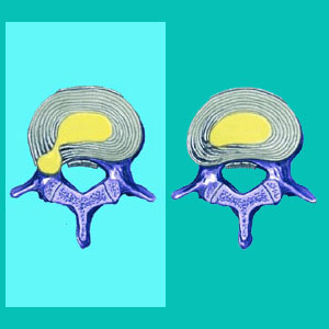 herniated disc guide