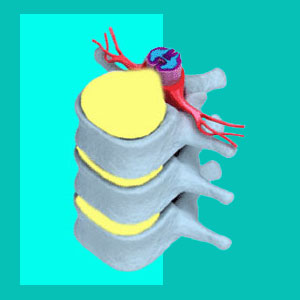 herniated disc impinging on the thecal sac