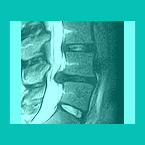 herniated disc myelopathy