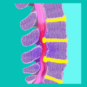 herniated disc spinal stenosis