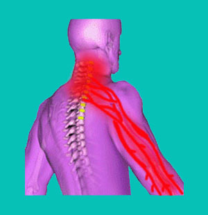 herniated disc weak arm