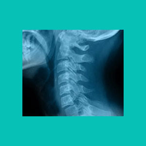 herniated disc x-ray