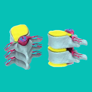 herniated discs in children