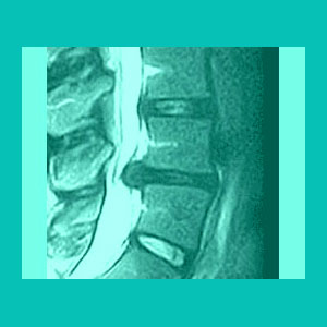 ligamentum flavum hypertrophy