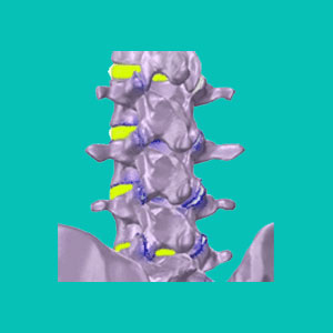 lumbar degenerative disc disease treatment