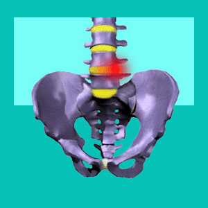 lumbar herniated disc