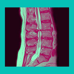 lumbar herniated disc spinal stenosis