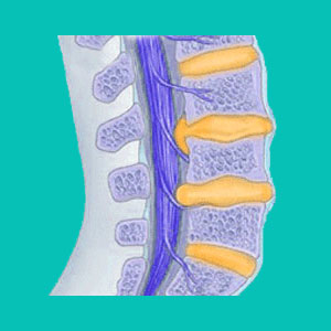 median herniated disc