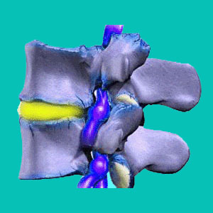 neuroforamen