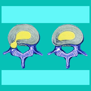 paramedial herniated disc