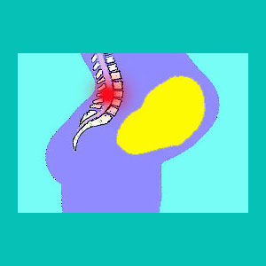 herniated disc pregnancy