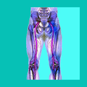sciatica