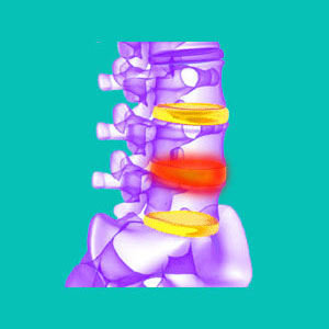 swollen spinal disc