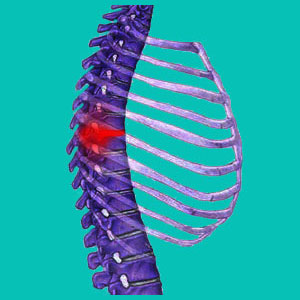 thoracic bulging disc