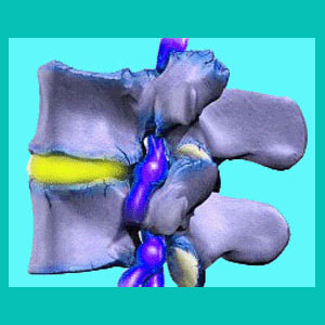 thoracic herniated disc pinched nerve