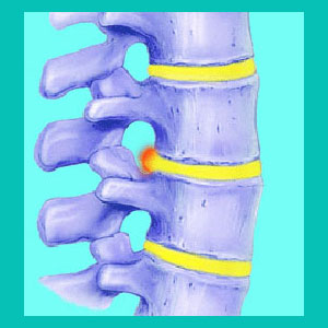 what is a herniated disc?